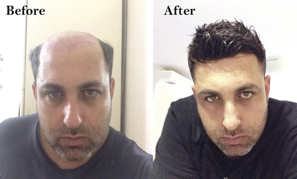 pose complement capillaire homme